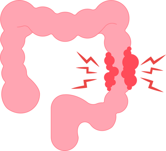 diverticulitis
